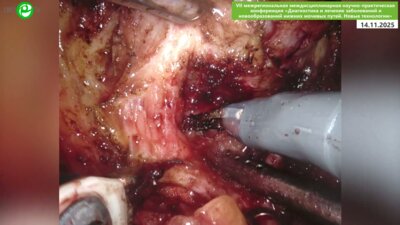 Безруков Е.А. - Робот-ассистированная простатэктомия с нервосбережением