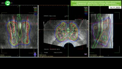 Цыбульский А.Д., Пчелинцев А.С. - Высокодозная брахитерапия локализованного рака простаты микроисточником Кобальт-60