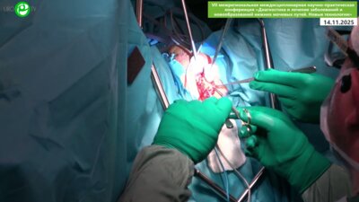 Живов А.В. - Аугментационная пластика уретры по методу Dorsal only с применением ICG-визуализации