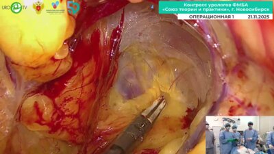 Волокитин Е.В. - Лапароскопическая аденомэктомия