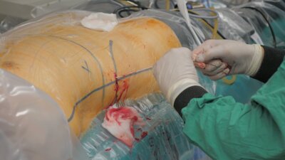 Мартов А.Г. - Миниперкутанная нефролитотрипсия с применением гольмиевого лазера CALCULASE III