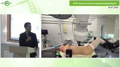 Аллахвердиев О.Н. - Хирургическое лечение фиброэпителиальных полипов верхних мочевых путей больших размеров