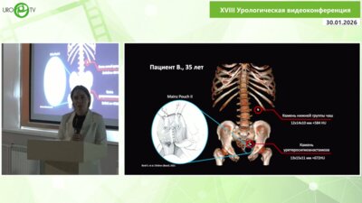 Алоян Ж.С.  - Применение аспирационного мочеточникового кожуха у пациента с уретеросигмоанастомозом