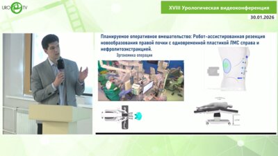 Гнеев Н.Ю. - Роботическая резекция почки с одновременной пластикой ЛМС и литоэкстракцией
