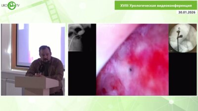 Доломанов К.А. - Коварство чашечкового дивертикула. Останавливаем венозное кровотечение