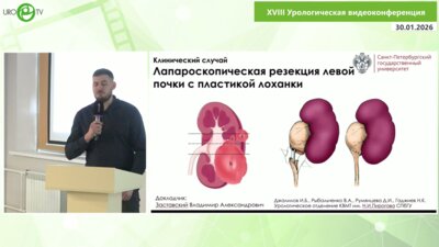 Заставский В.А. - Лапароскопическая резекция левой почки с пластикой лоханочно-мочеточникового сегмента