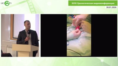 Ирицян М.М. - Графтинг белочной оболочки полового члена при Болезни Пейрони