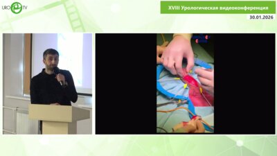 Ирицян М.М. - Уретропластика Dorsal inlay у пациента с гипоспадией и лихен склерозом