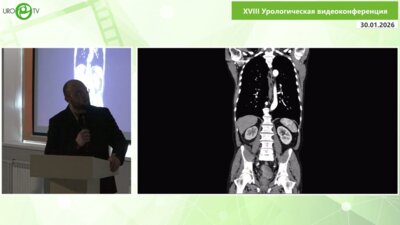 Канукоев А.Г. - Перкутанная резекция опухоли лоханки: клинический опыт органосохраняющего лечения рака лоханки при первично-множественном раке