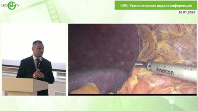 Левонян А.Г.  - Лапароскопическая аугментационная буккальная onlay пластика верхней трети левого мочеточника с фибропиелолитоэкс