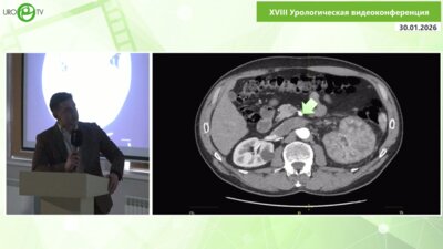 Лысёнок А.Ю. - Лапароскопическая резекция тромба нижней полой вены при раке левой почки