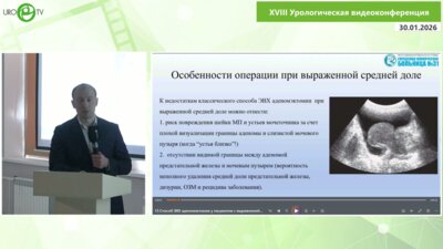 Очеленко В.А. - Способ ЭВХ аденомэктомии у пациентов с выраженной средней долей