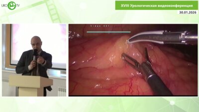 Шкодкин С.В. - Рецидивная стриктура правого мочеточника, ретероилеопластика справа