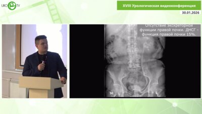 Трушкин Р.Н., Медведев П.Е., Исаев Т.К., Иванов К.В., Щеглов Н.Е.- Лапароскопический уретероцистоанастомоз (по Боари)