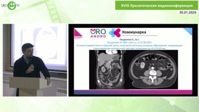 Тызьо Д.В. - От невозможного к стандарту: робот-ассистированная резекция почки при RENAL 10+