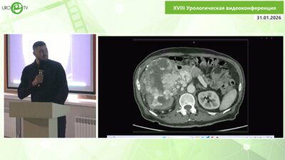 Заставский В.А. - Лапароскопическая нефрэктомия с тромбэктомией II уровня
