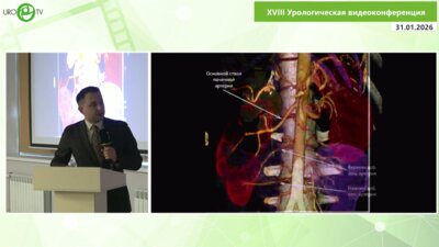 Исаев Т.К. - Лапароскопическая реконструкция ЛМС в условиях сложной сосудистой анатомии