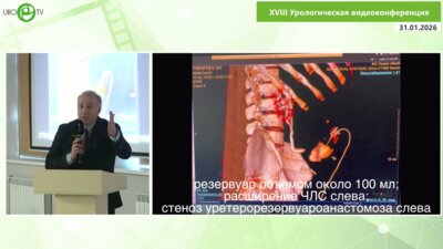 Козырев Г.В. - Недержание мочи при экстрофии — долгая дорога к успеху (реконструкция необладдера)