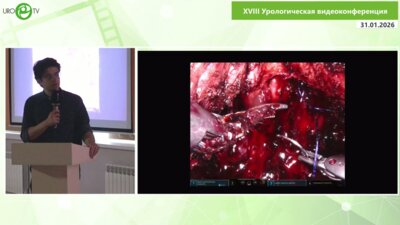 Маммаев Р.У. - Нетипичные случаи простатэктомии со сбережением пространства Ретциуса