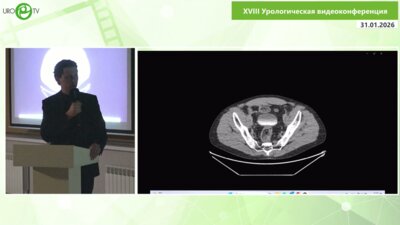 Степанченко В.С. - Лапароскопическая резекция мочевого пузыря при опухоли урахуса