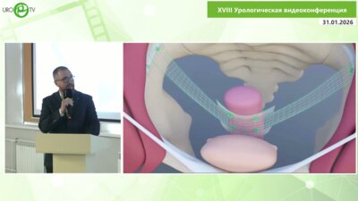 Сучков Д.А. - Унилатеральная пектопексия