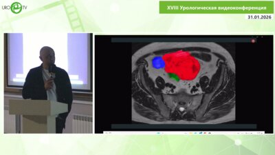 Шкодкин С.В. - Большая неэпителиальная опухоль мочевого пузыря или кишки