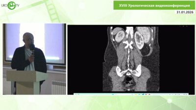 Шкодкин С.В. - Мочевой перитонит после ранения мочеточника