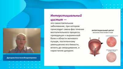 Дроздова А.В. - Интерстициальный цистит