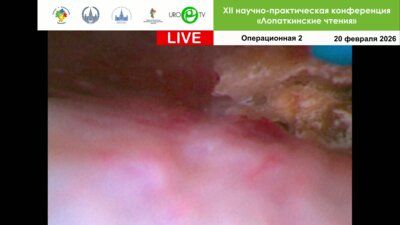 Ретроградная интраренальная хирургия с аспирационным кожухом. Оператор Малхасян В.А.