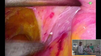 Новиков А.Б. - Visera Elite III Yellow Enhancement