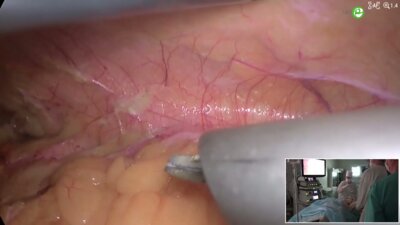 Кочетов А.Г. - Лапороскопическая эпигеминефрэктомия (ICG)