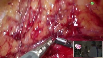 Санжаров А.Е. - Лапароскопическая пластика