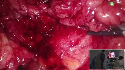 Перлин Д.В. - Ретроперитонеоскопическая резекция почки