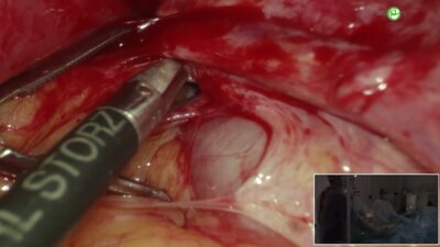 Помешкин Е.В. - Мочеточниково-влагалищный свищ