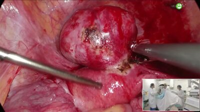 Белкина Н.Н. - Лапароскопическая мномэктомия