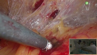 Вязовцев П.В. - Киста почки Bosniak