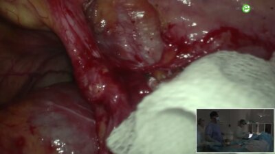 Галлямов Э.А. - Лапароскопическая реимплантация