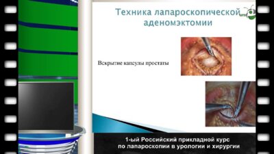 Биктимиров Р.Г. - "Лапароскопическая внебрюшинная(ретроперитонеоскопическая) аденомэктомия простаты"