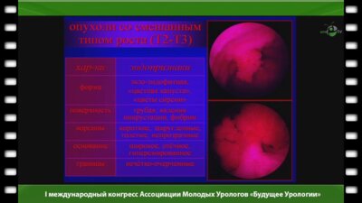 Мартов А.Г. - "Эндоскопические возможности диагностики рака мочевого пузыря"