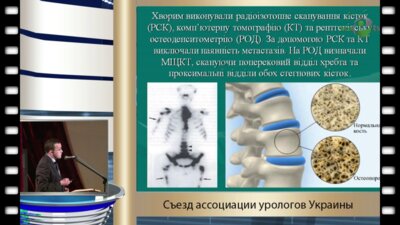 Черниченко О.А. - "Нарушения минеральной плотности костей у больных раком предстательной железы, которые получают интермитиручую гормонотерапию"