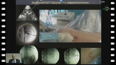 Арустамов Л.Д. - "Бездренажная перкутанная нефролитотрипсия в лечении нефролитиаза у детей." 