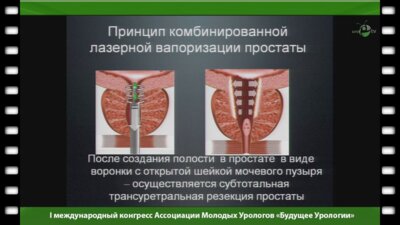Холтобин Д. - "3-х летний опыт лазерной вапоризации простаты высокомощным диодным лазером Дорнье уробим"