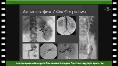 Волков С.В. - "Возможности эндоваскулярной хирургии в урологии"
