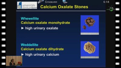 Siener R. - "Патогенетическая информация из анализа камней"