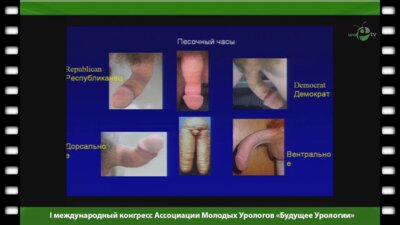 Рейблат П. - "Лечение болезни Пейрони"