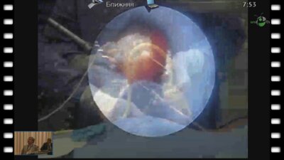 Trinchiery A. - Видео лежа PCNL