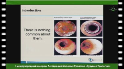 Осама Т. Абдулдахаб - "Применение металических стентов в урологии"