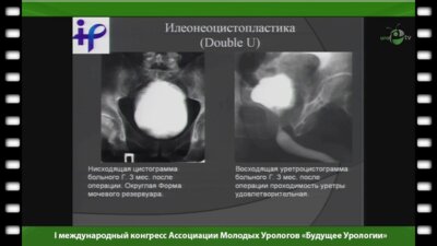 Яцина А. - "Уродинамика артифициального мочевого пузыря"