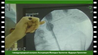 Установка уретерального стента "Memokath"