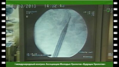 Чрескожная нефролитотомия